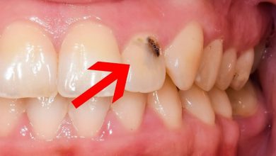تصویر از راه های پیشگیری از پوسیدگی دندان، جلوگیری از خراب شدن دندان چگونه است؟